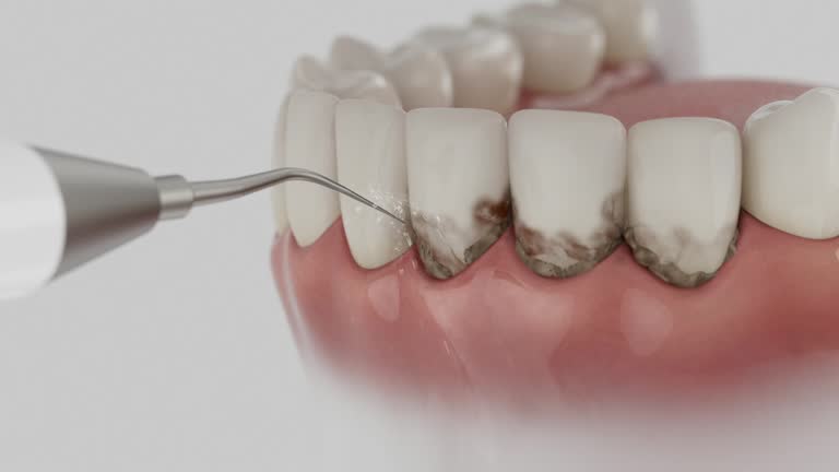 Trusted Wisdom Tooth Removal service in Weaver, AL - Dentist Open Now